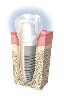 Implantologie dentaire à Bailleul